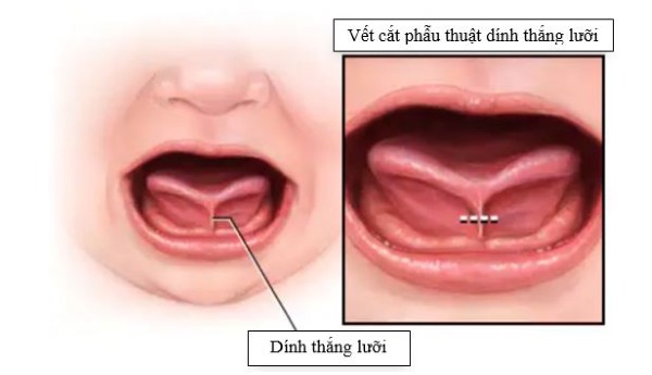 Điều trị dính thắng lưỡi là gì cần tùy thuộc vào mức độ nặng nhẹ của trẻ