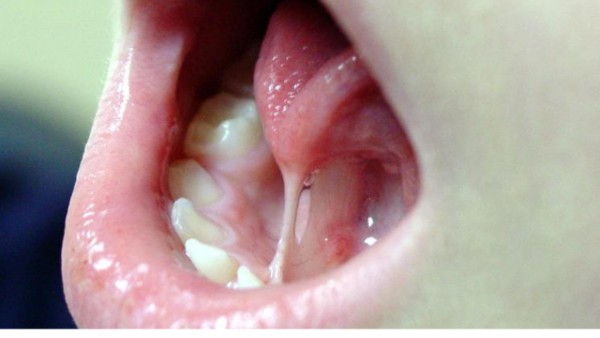 Những lầm tưởng phổ biến về dính thắng lưỡi