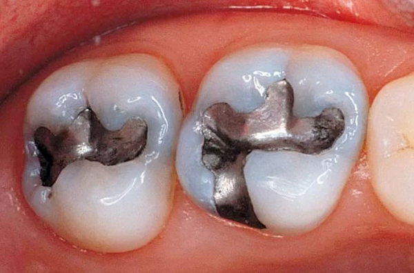 Trám răng khi tủy vẫn chưa bị ảnh hưởng