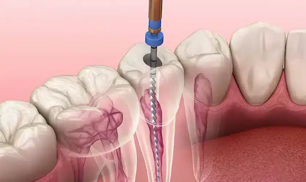 Lấy tủy răng khi tủy bị viêm nhiễm hoặc hoại tử