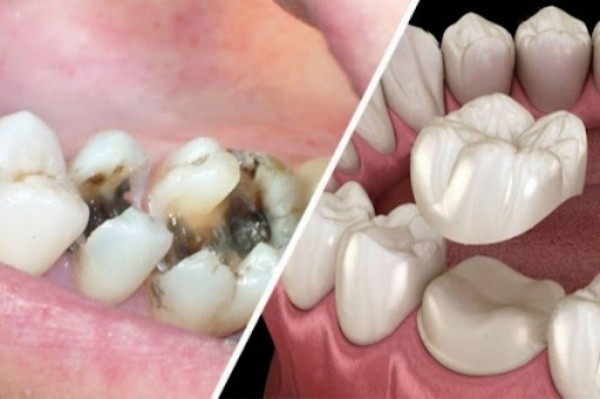 Bọc răng sứ sau khi xử lý sâu và lấy tủy
