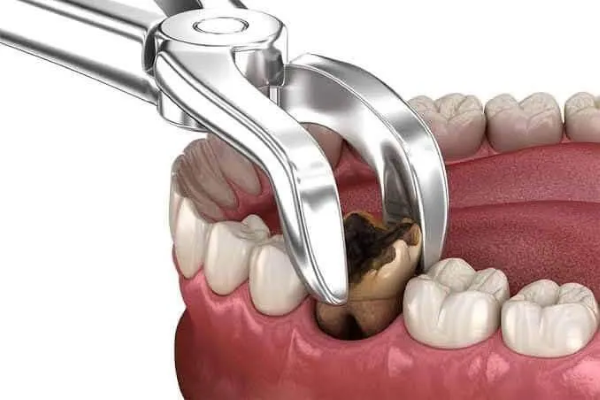 Nhổ răng sâu độ 3 khi răng quá yếu hoặc bị hư hỏng nặng