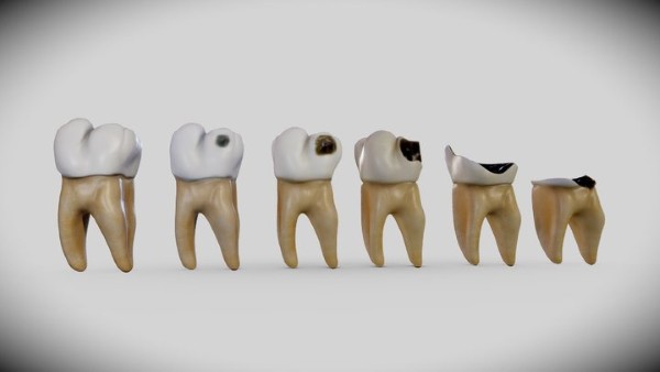 Răng sâu độ 3 so với các mức độ khác
