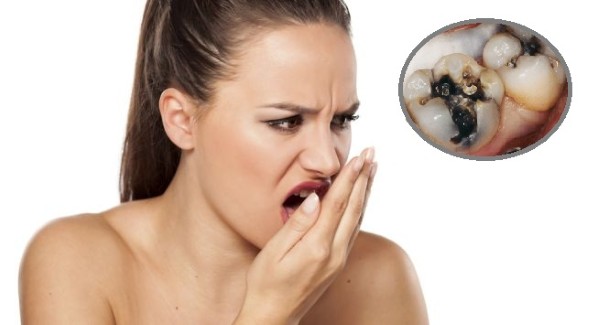 Răng sâu độ 3 thường làm khoang miệng có mùi hôi khó chịu kéo dài