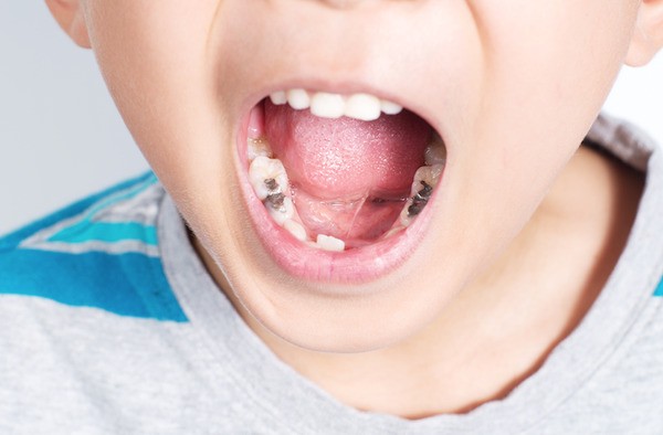 Trám răng dành cho trường hợp răng sữa bị sâu ở mức độ nhẹ