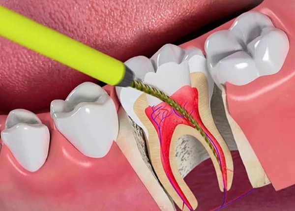 Điều trị tủy khi răng sữa bị sâu lan đến tủy gây viêm hoặc hoại tử