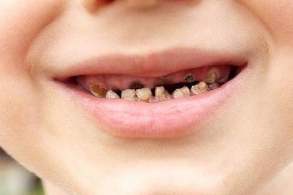 Dấu hiệu nhận biết răng sữa bị sâu ở trẻ