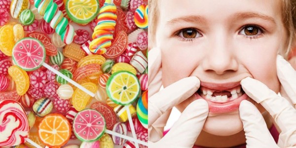 Răng sữa bị sâu do bé thường xuyên ăn đồ ngọt quá nhiều
