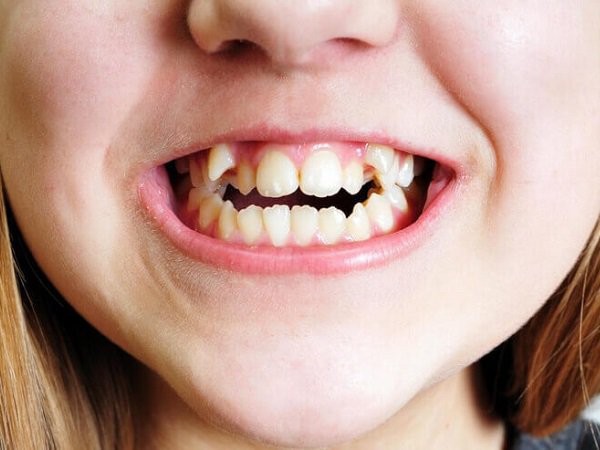 Hàm răng của trẻ mọc lệch dễ dàng hình thành răng sữa bị sâu