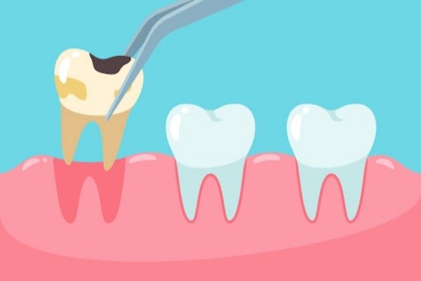 Nhổ răng sữa bị sâu tùy thuộc vào mức độ tổn thương và các trường hợp khác nhau