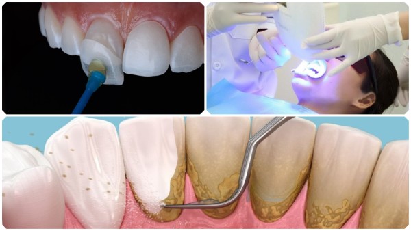 Các phương pháp điều trị và làm trắng răng vàng