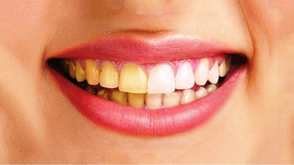 Các câu hỏi thường gặp về tình trạng răng vàng