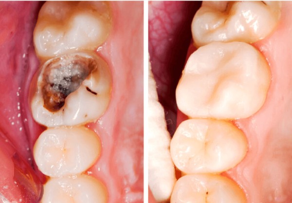 Trám răng sâu là kỹ thuật nha khoa phổ biến nhằm khôi phục những vùng răng bị tổn thương do sâu răng gây ra
