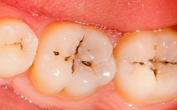 Sâu răng giai đoạn đầu là thời điểm vàng để trám răng