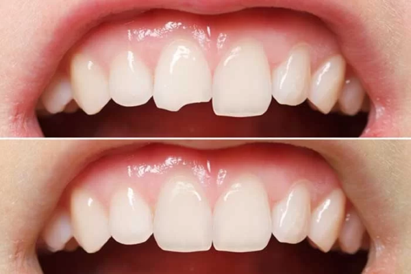 Trám răng bị sứt mẻ hoặc bị chấn thương