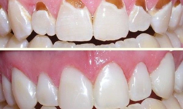Trám cho răng bị mòn men