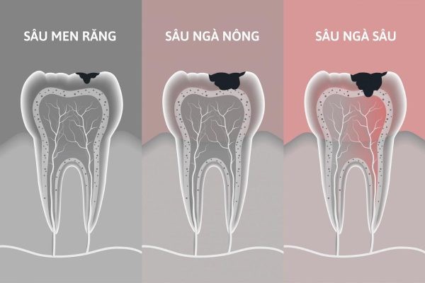 Trám răng sâu có đau không tùy vào mức độ sâu của răng