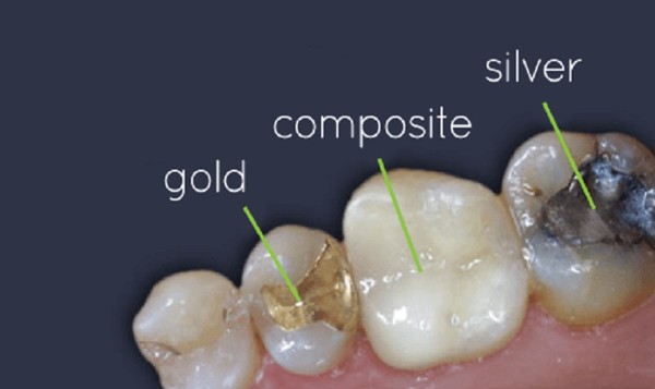 Vật liệu sử dụng cũng là yếu tố ảnh hưởng đến việc trám răng có đau không