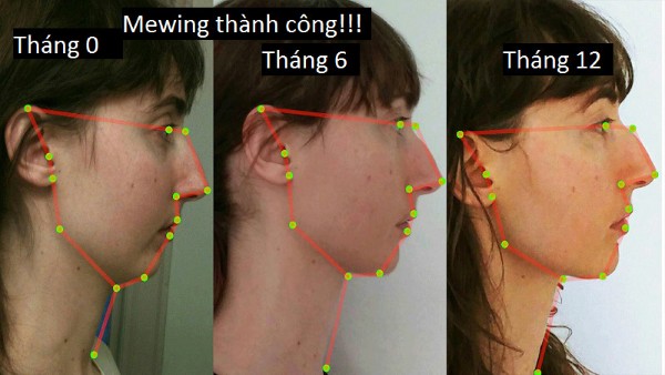 Việc thực hành cách mewing mang đến nhiều lợi ích