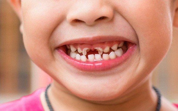 Trẻ bị mất răng sữa sớm và ảnh hưởng đến quá trình mọc răng vĩnh viễn