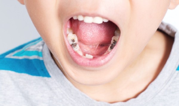 Trám răng cũng là một cách chữa sâu răng cho trẻ 4 tuổi được áp dụng rộng rãi
