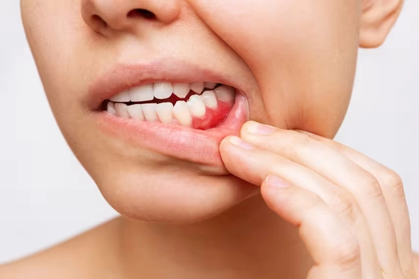 Dấu hiệu nhận biết răng khôn bị sâu cần xử lý sớm