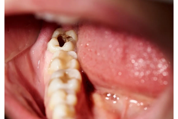Răng khôn bị sâu không điều trị có nguy hiểm không?