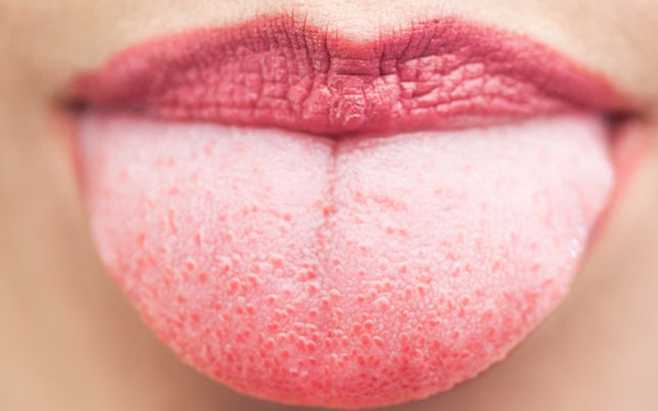 Lưỡi trắng là tình trạng do nhiều nguyên nhân khác nhau gây ra