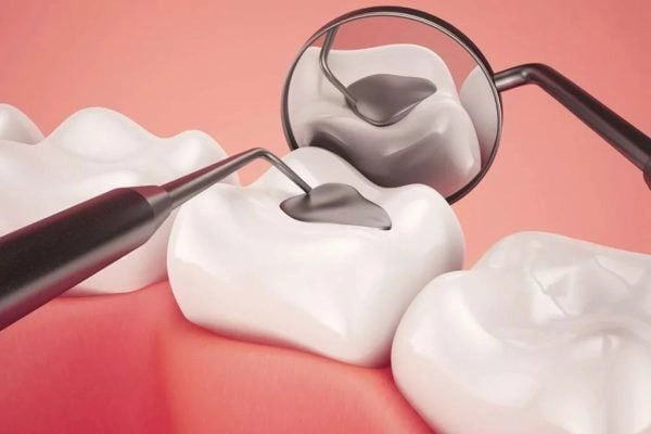 Trám răng tại phòng khám Nha Khoa Sài Gòn