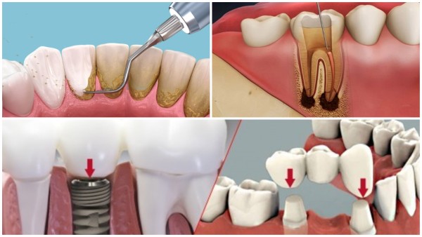 Các phương pháp điều trị chân răng bị đen thường được sử dụng