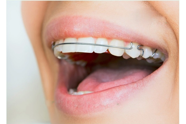 Cần đeo hàm duy trì trong bao lâu? Cần đeo hàm duy trì trong bao lâu?