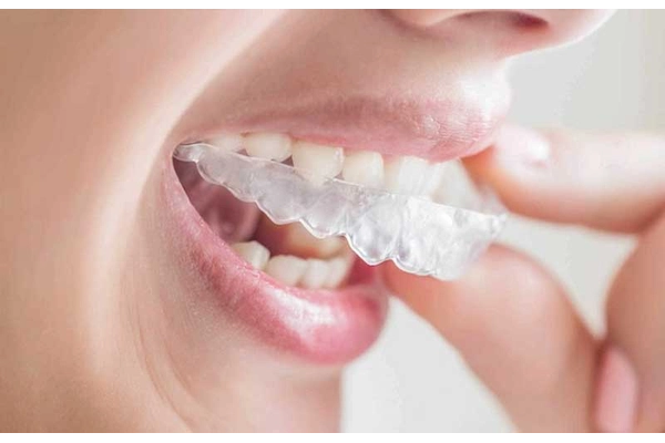 Quy trình làm hàm duy trì chuẩn y khoa tại Nha khoa Sài Gòn Phong Phú Quy trình làm hàm duy trì chuẩn y khoa tại Nha khoa Sài Gòn Phong Phú