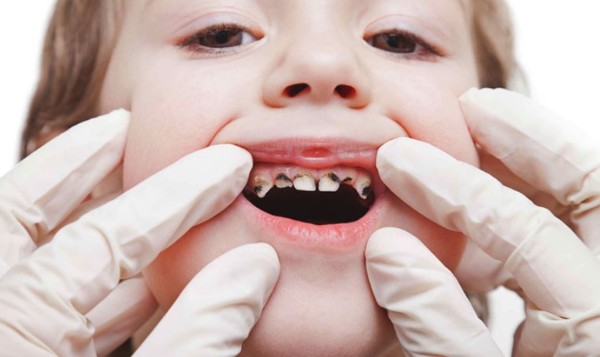 Sâu răng ở trẻ là tình trạng tổn thương cấu trúc răng do vi khuẩn gây ra