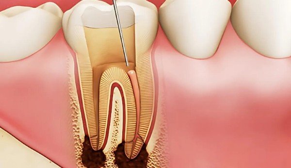 Lấy tủy khi cần thiết để giữ lại chiếc răng thật cho trẻ