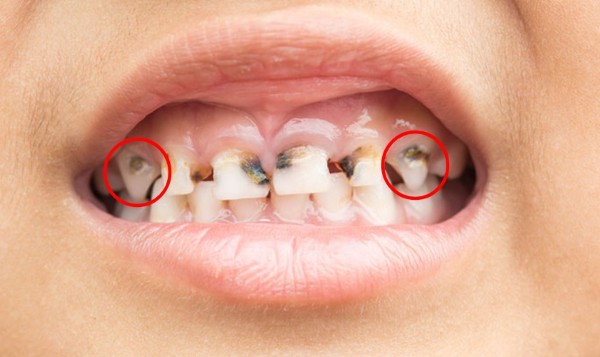 Tầm quan trọng của hình ảnh sâu răng ở trẻ em
