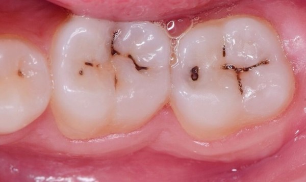 Dáu hiệu nhận biết qua hình ảnh sâu răng ở trẻ