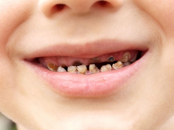 Các yếu tố khác góp phần gây sâu răng ở trẻ