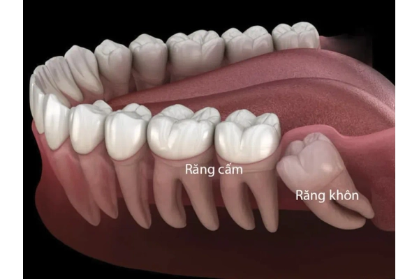 Răng cấm là gì? Răng cấm là gì?