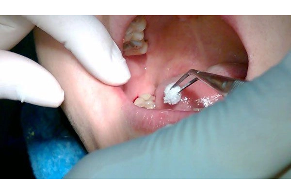 Quy trình nhổ răng cấm an toàn tại nha khoa Quy trình nhổ răng cấm an toàn tại nha khoa