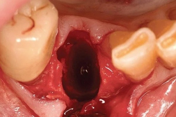 Các dấu hiệu bất thường sau khi nhổ răng cần tái khám