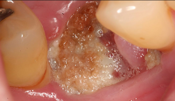 Các rủi ro có thể gặp khi nhổ răng hàm trên trong cùng bị sâu