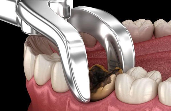 Quy trình nhổ răng hàm trên trong cùng bị sâu chuẩn y khoa