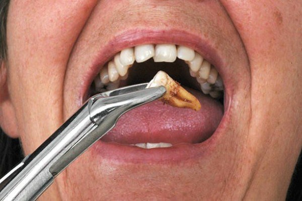 Những đối tượng cần thận trọng khi nhổ răng hàm trên trong cùng bị sâu