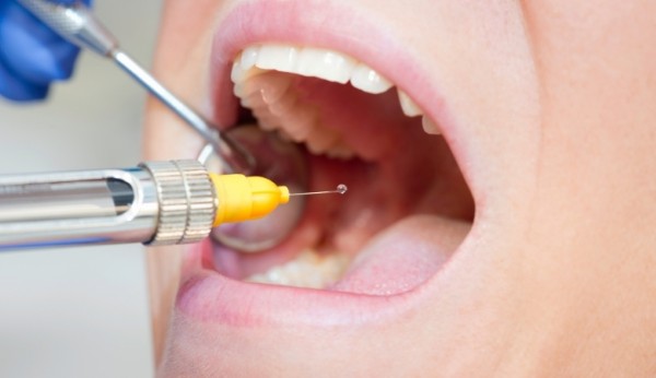 Nhổ răng hàm trên trong cùng bị sâu với phương pháp gây tê không đau