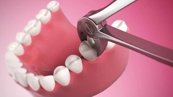 Việc nhổ răng hàm trên trong cùng bị sâu làm ảnh hưởng đến cấu trúc xương hàm và các răng bên cạnh