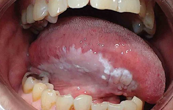 Niêm mạc là gì? Cấu tạo, chức năng, bệnh lý và cách chăm sóc hiệu quả 6 Niêm mạc là gì? Nguyên nhân gây tổn thương và viêm niêm mạc miệng