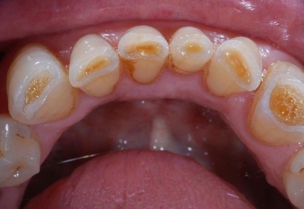Mòn men răng dẫn đến tình trạng răng bị ê buốt