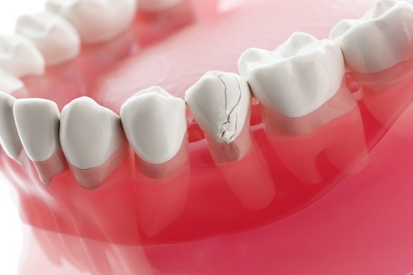 Răng bị ê buốt do chấn thương khiến răng nứt gãy