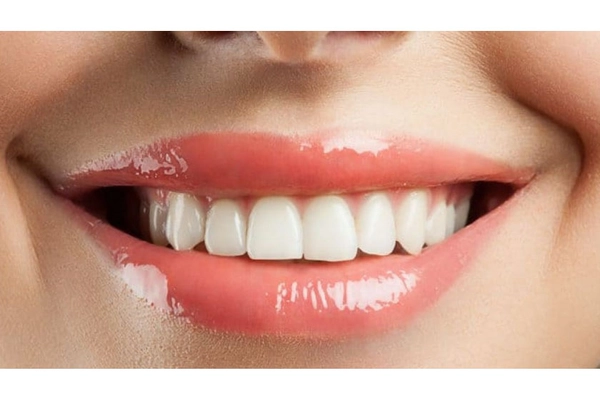 Giới thiệu chung về răng cửa