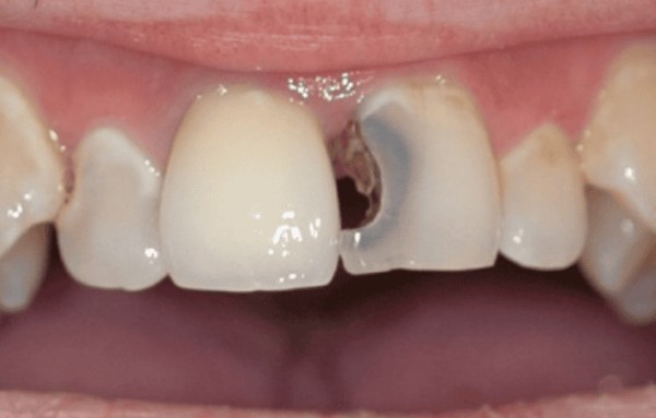 Răng sâu nặng có trám được không?